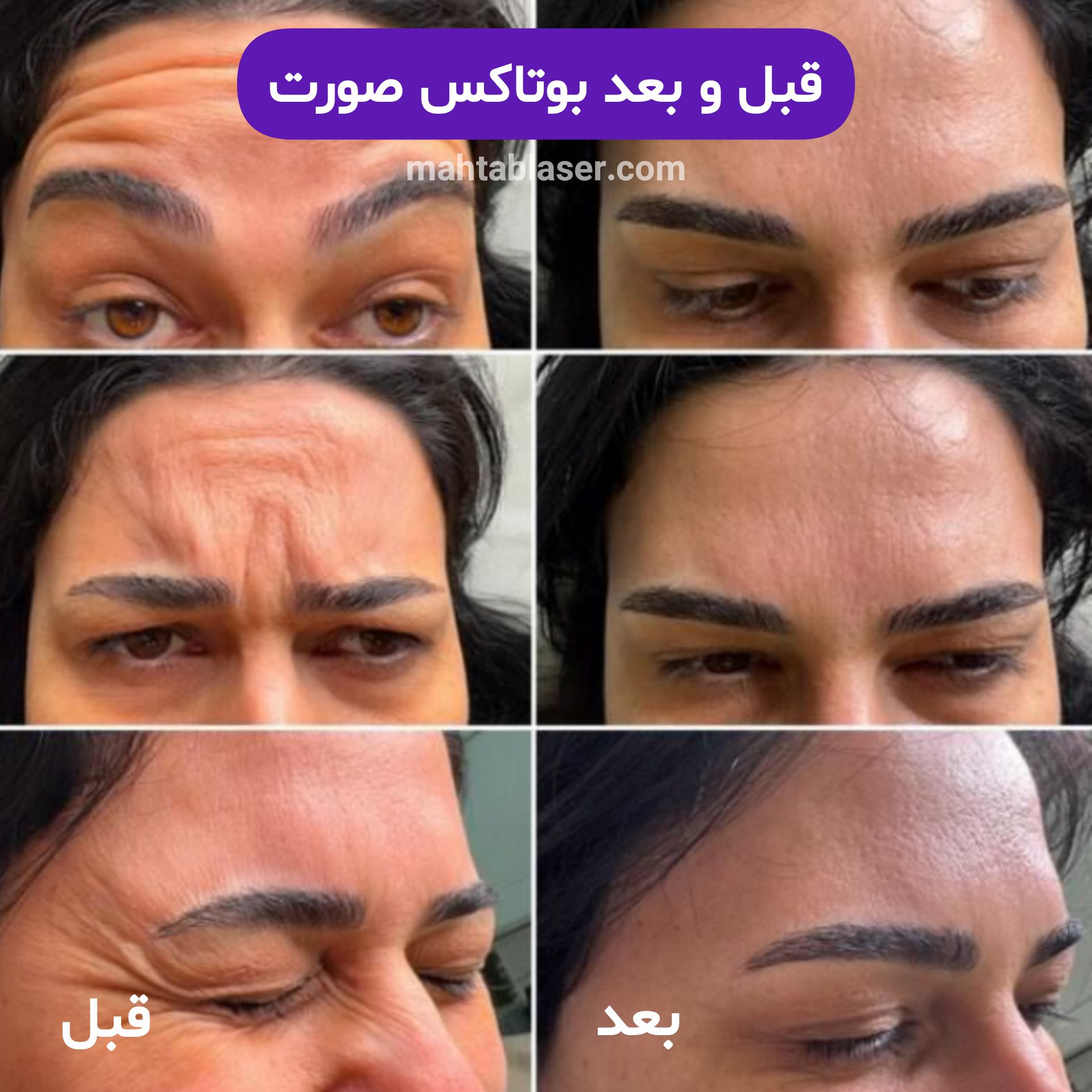 بوتاکس صورت در رشت