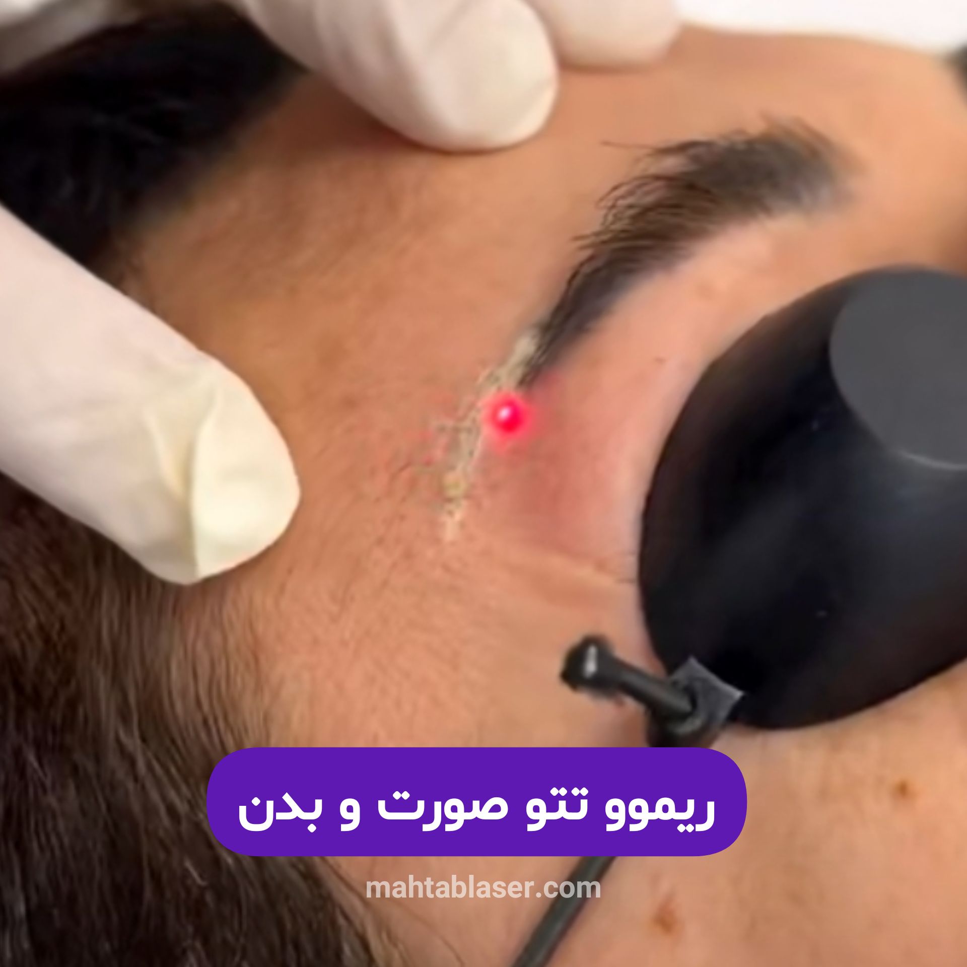 حذف یا برداشتن تاتو یا خالکوبی در گلسار رشت