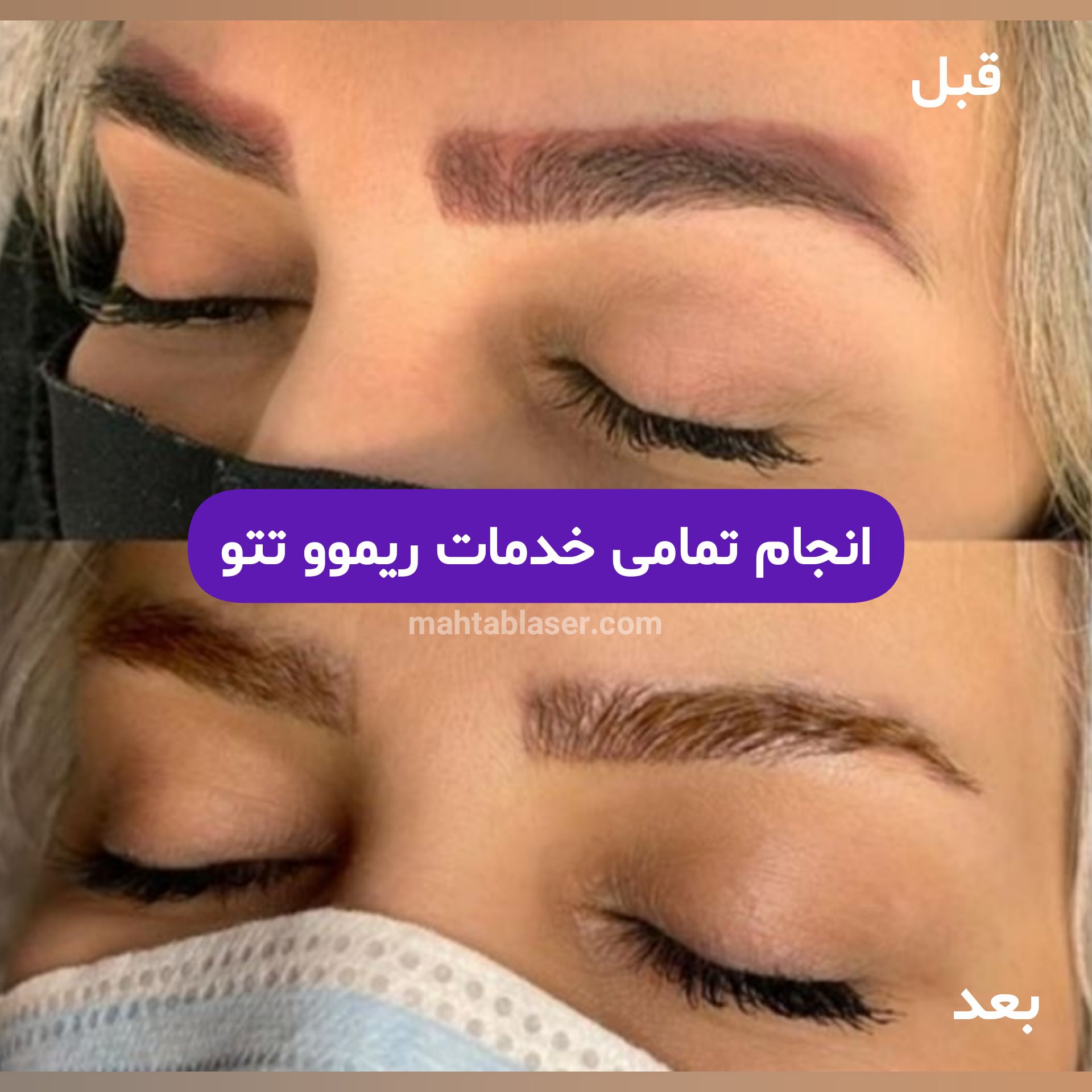 هزینه پاك كردن تاتو با ليزر رشت