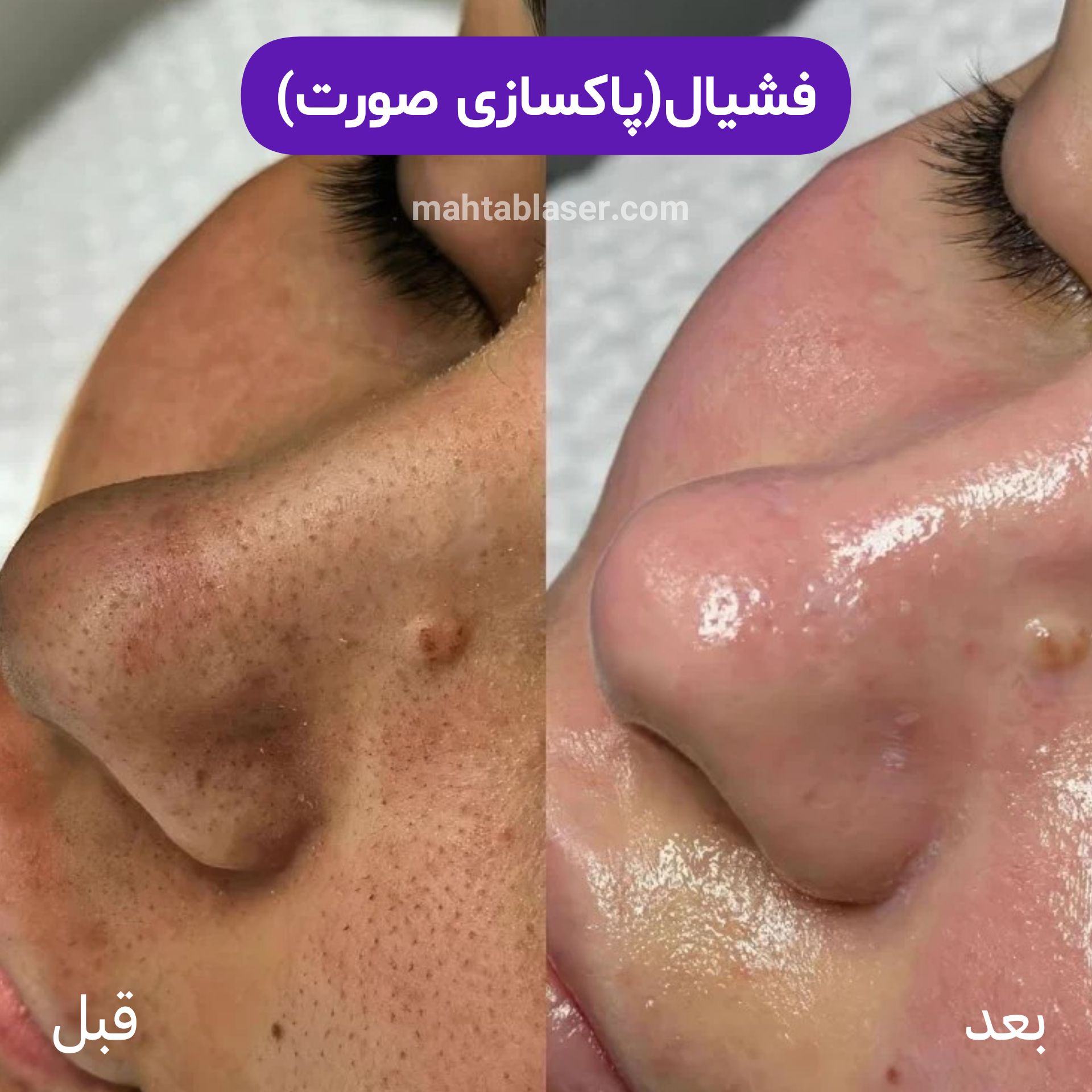 فیشیال یا پاکسازی و لایه برداری پوست در رشت