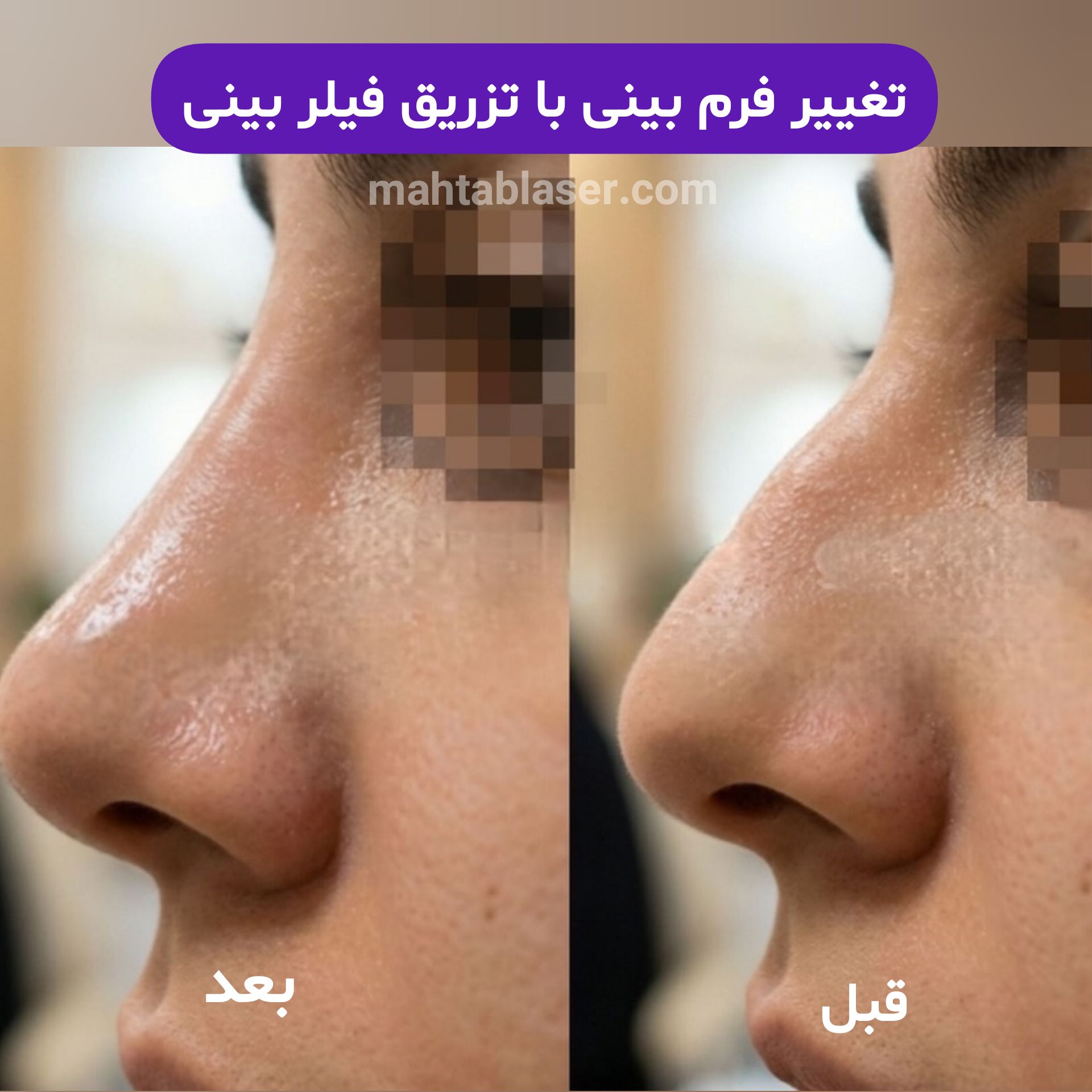 کوچک کردن بینی در رشت
