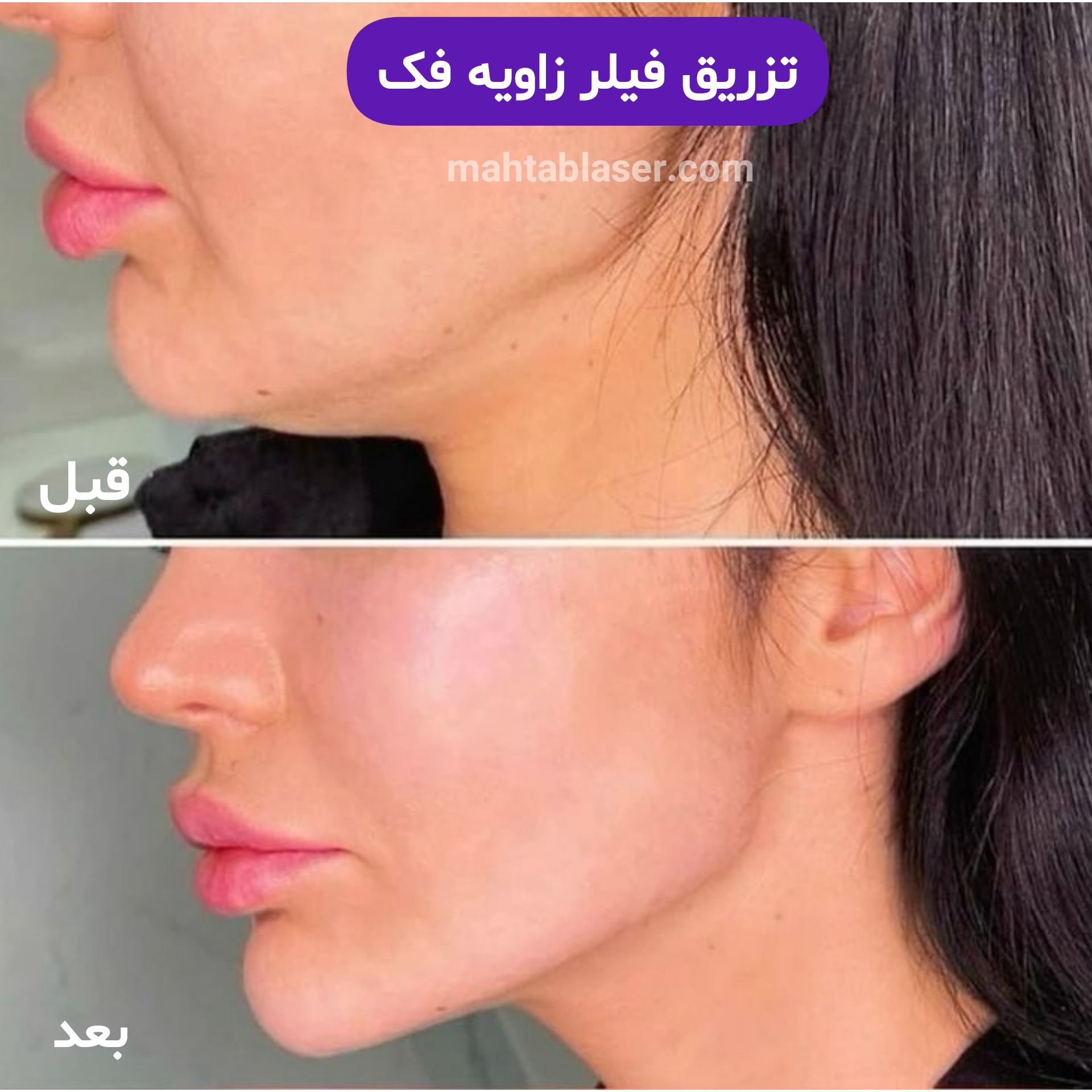 فیلر وزاویه سازی صورت در گلسار شهر رشت