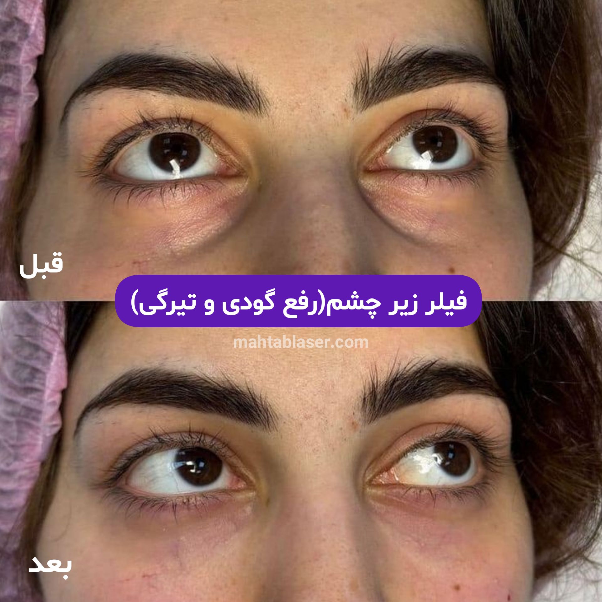 تزریق ژل زیر چشم در رشت