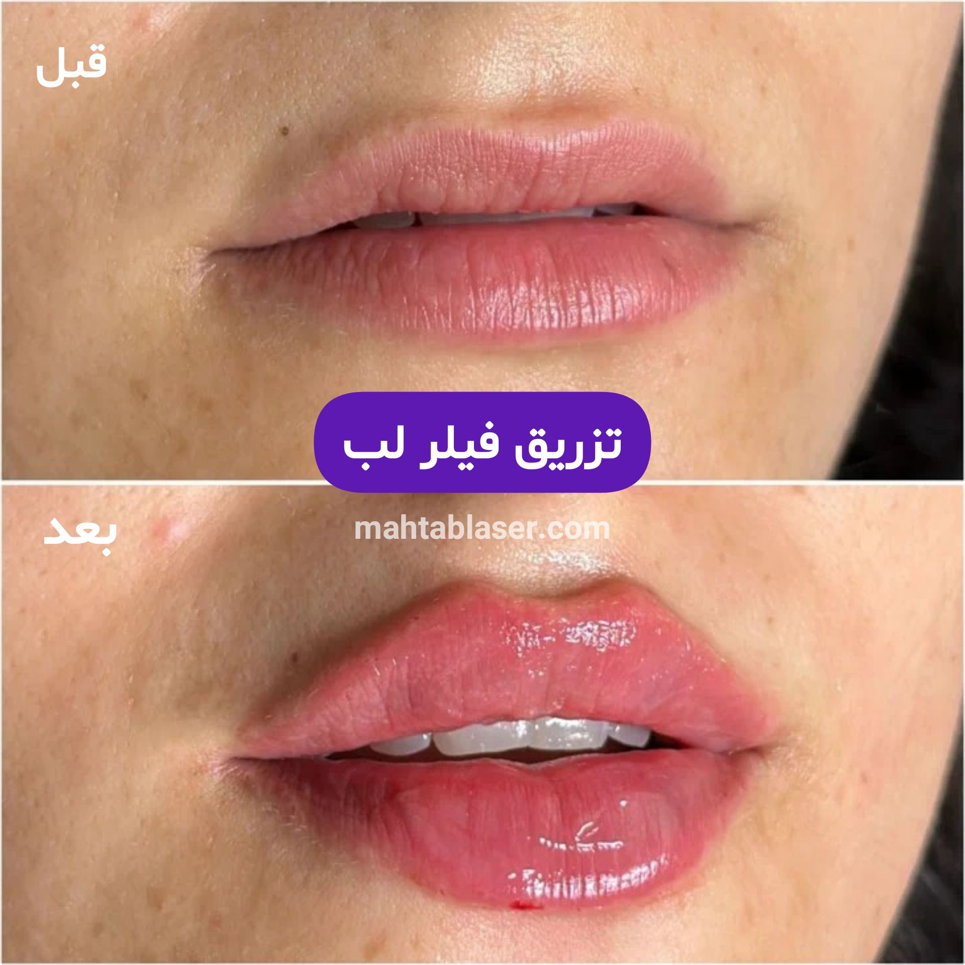 تزریق فیلر لب در رشت