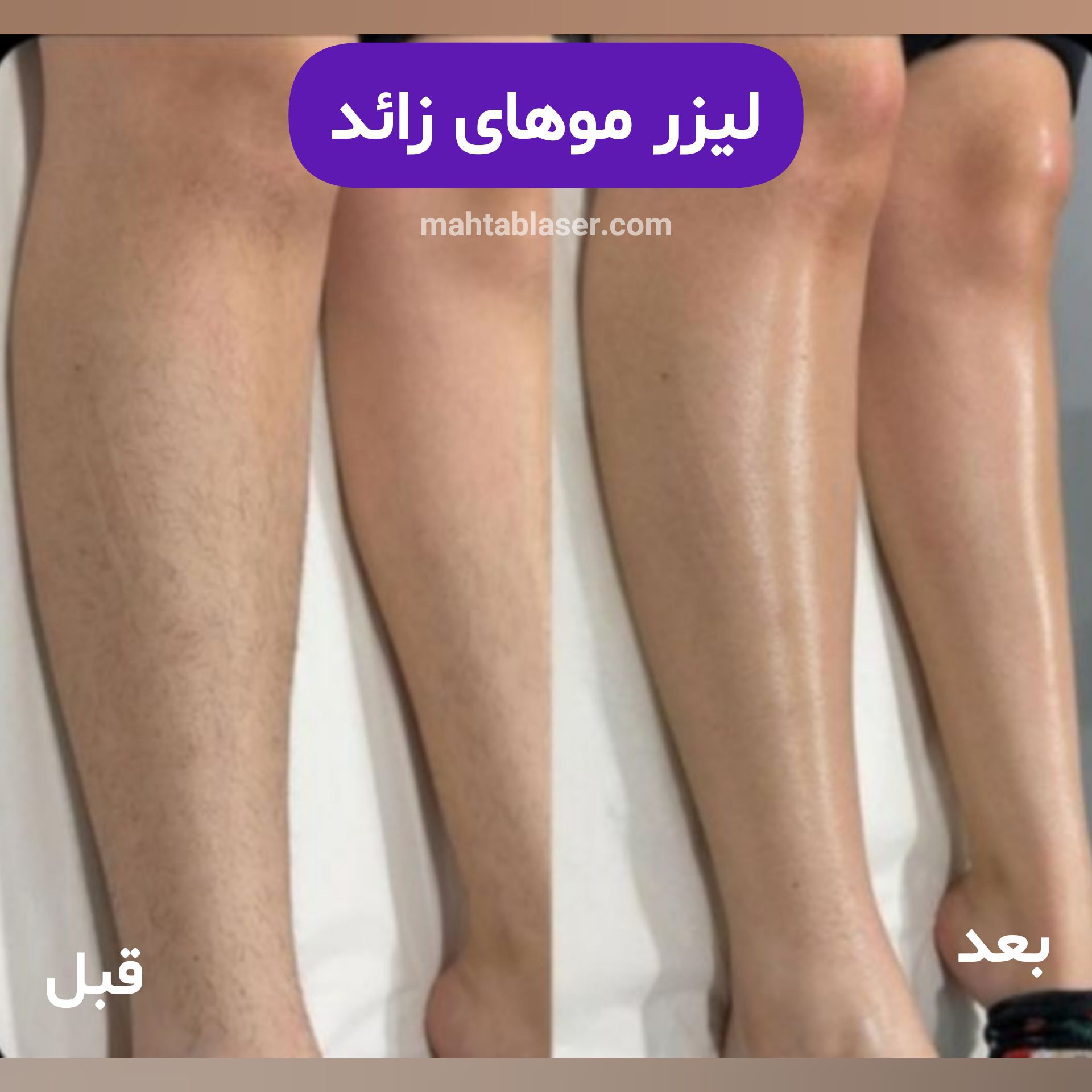 بهترین کلینیک لیزر موهای زائد در رشت