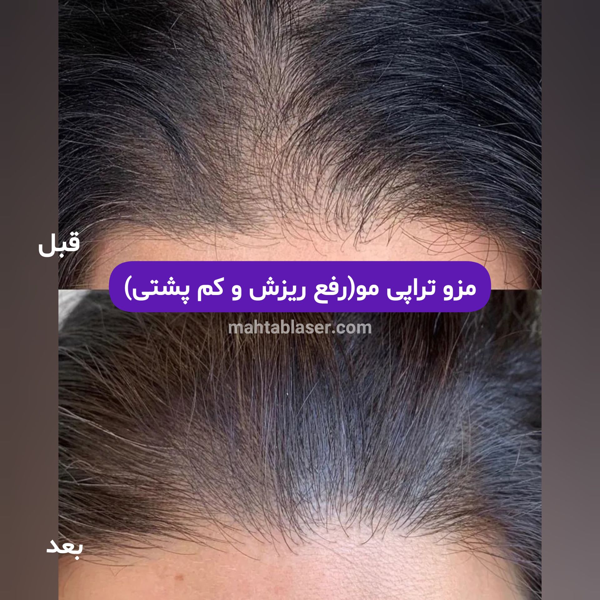 مزوتراپی مو در رشت