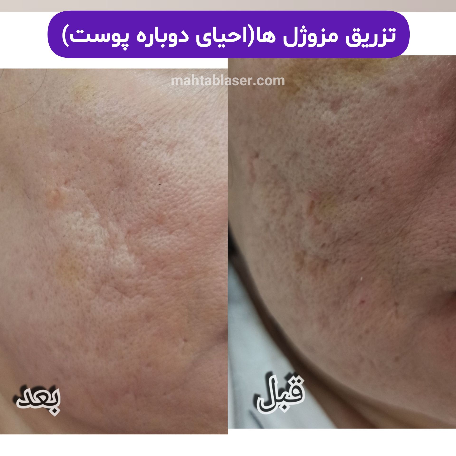 مزوژل جوانساز پروفایلو و جالپرو و دیمونو و لوکسیوا در کرج