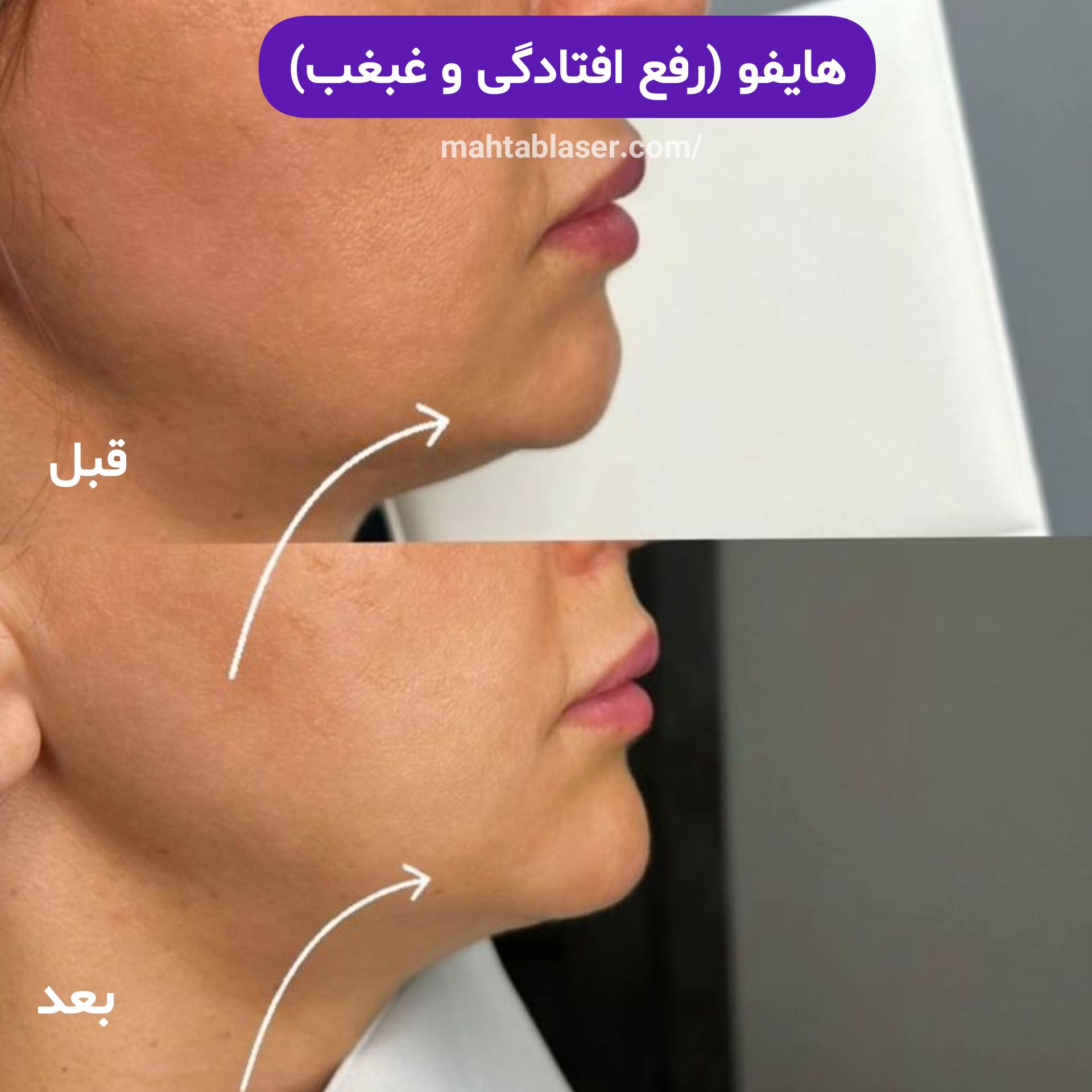 هایفو رفع افتادگی و غبغب در رشت