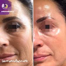 هایفوتراپی در کرج –جوانسازی صورت بدون جراحی در عظیمیه، گوهردشت، مهرشهر