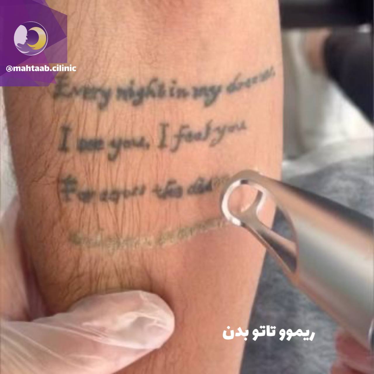 پاک کردن تاتو یا خالکوبی در کرج