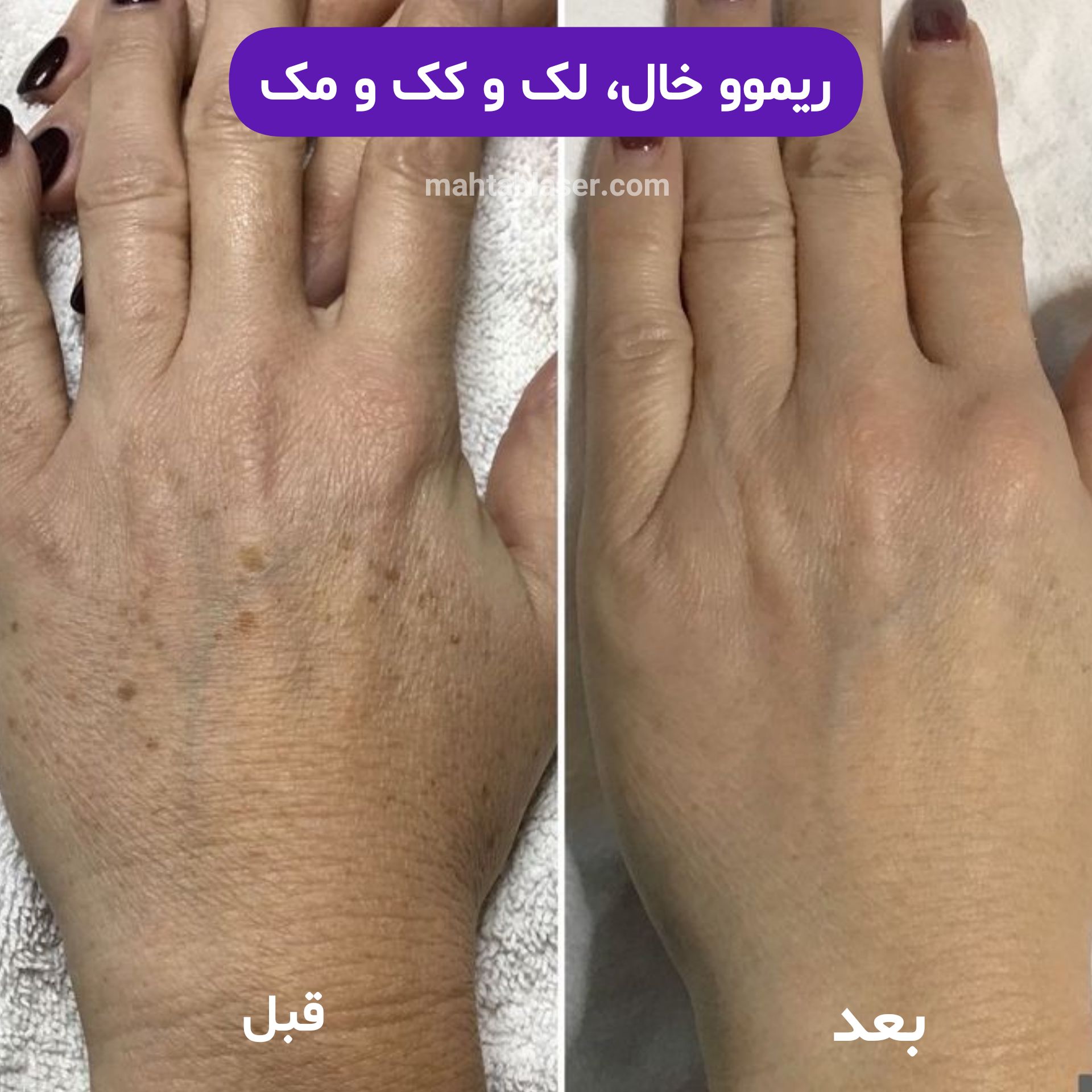 رفع کک و مک