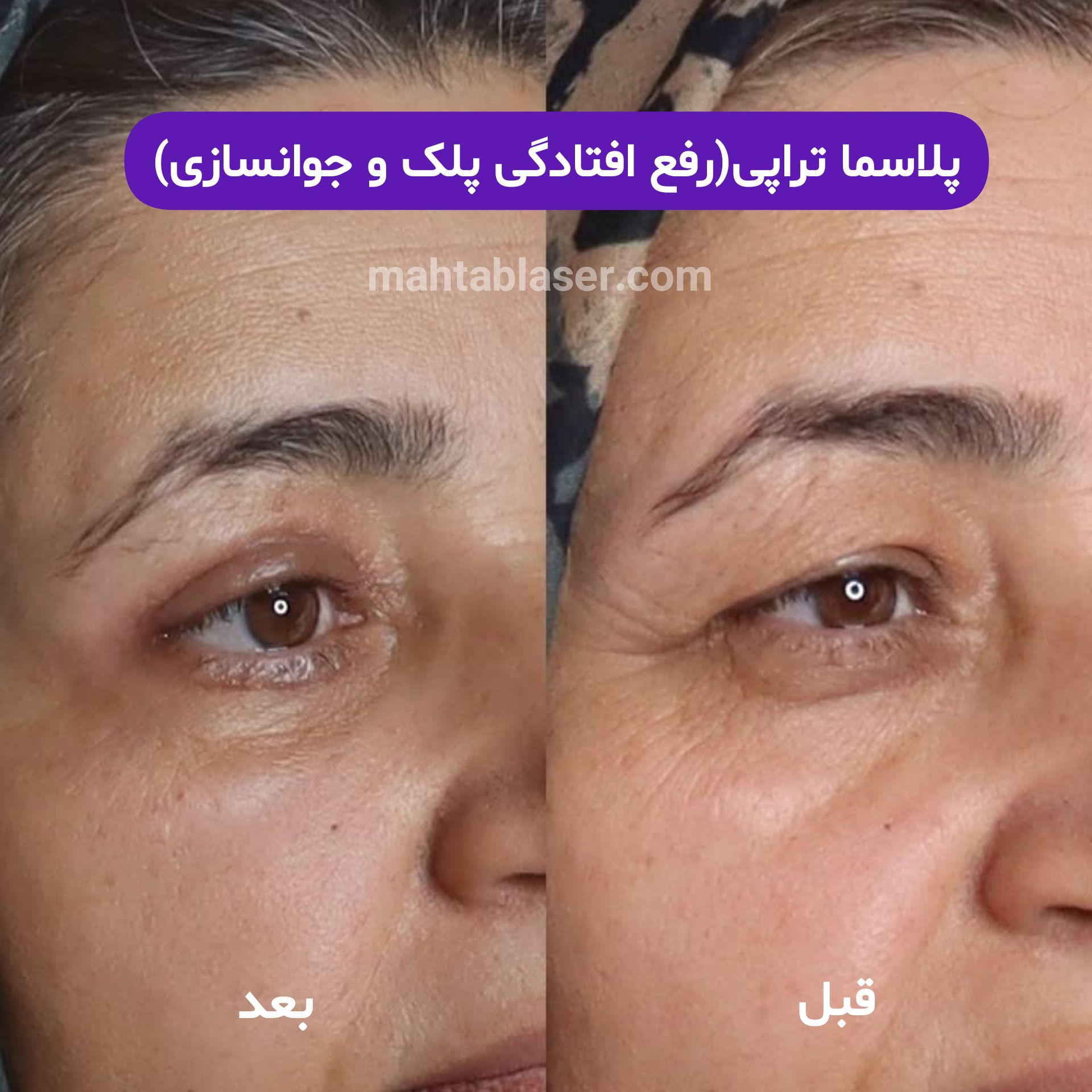 پلاسماتراپی یا رفع افتادگی پلک و کوچک کردن بینی در رشت