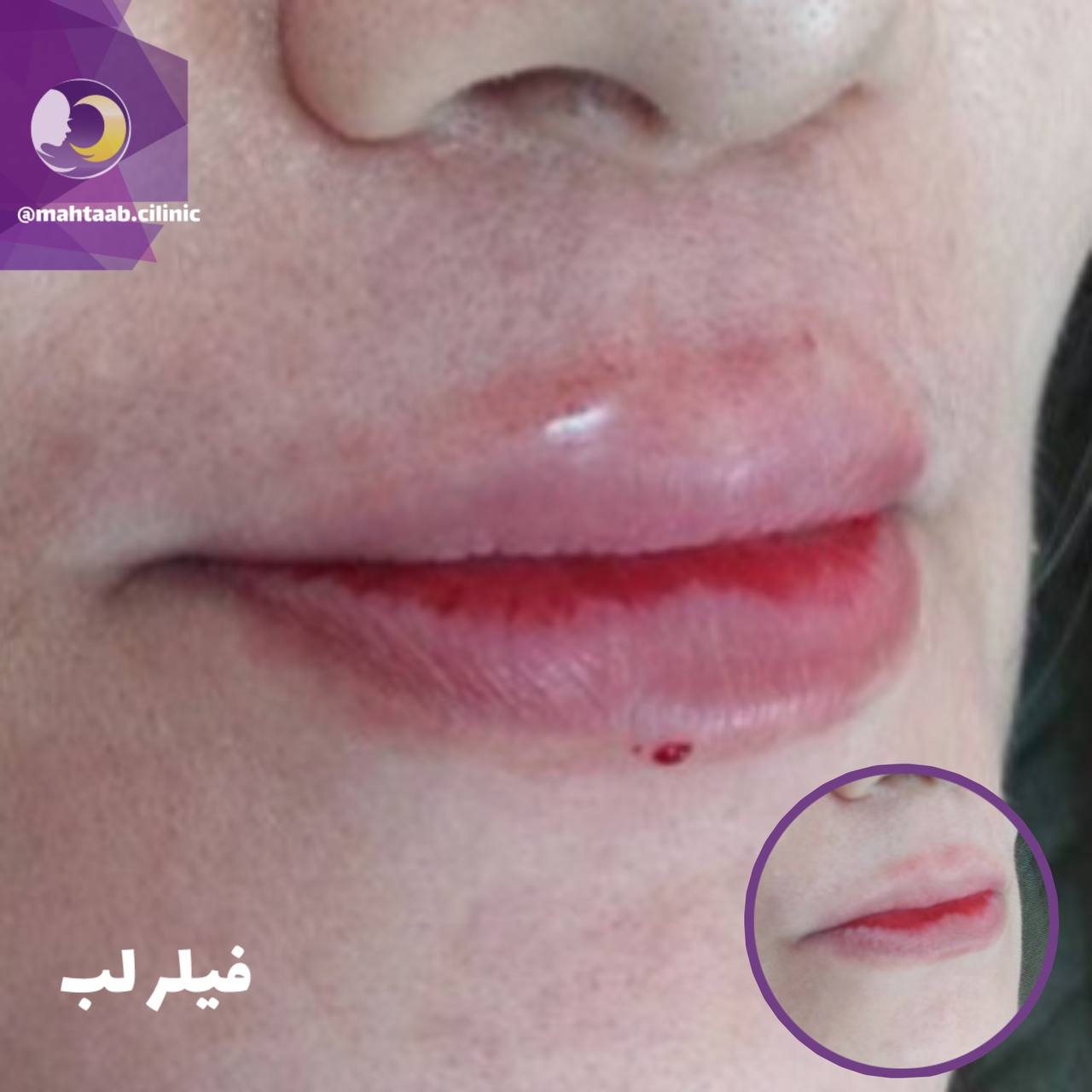 تزریق ژل لب و فیلر لب