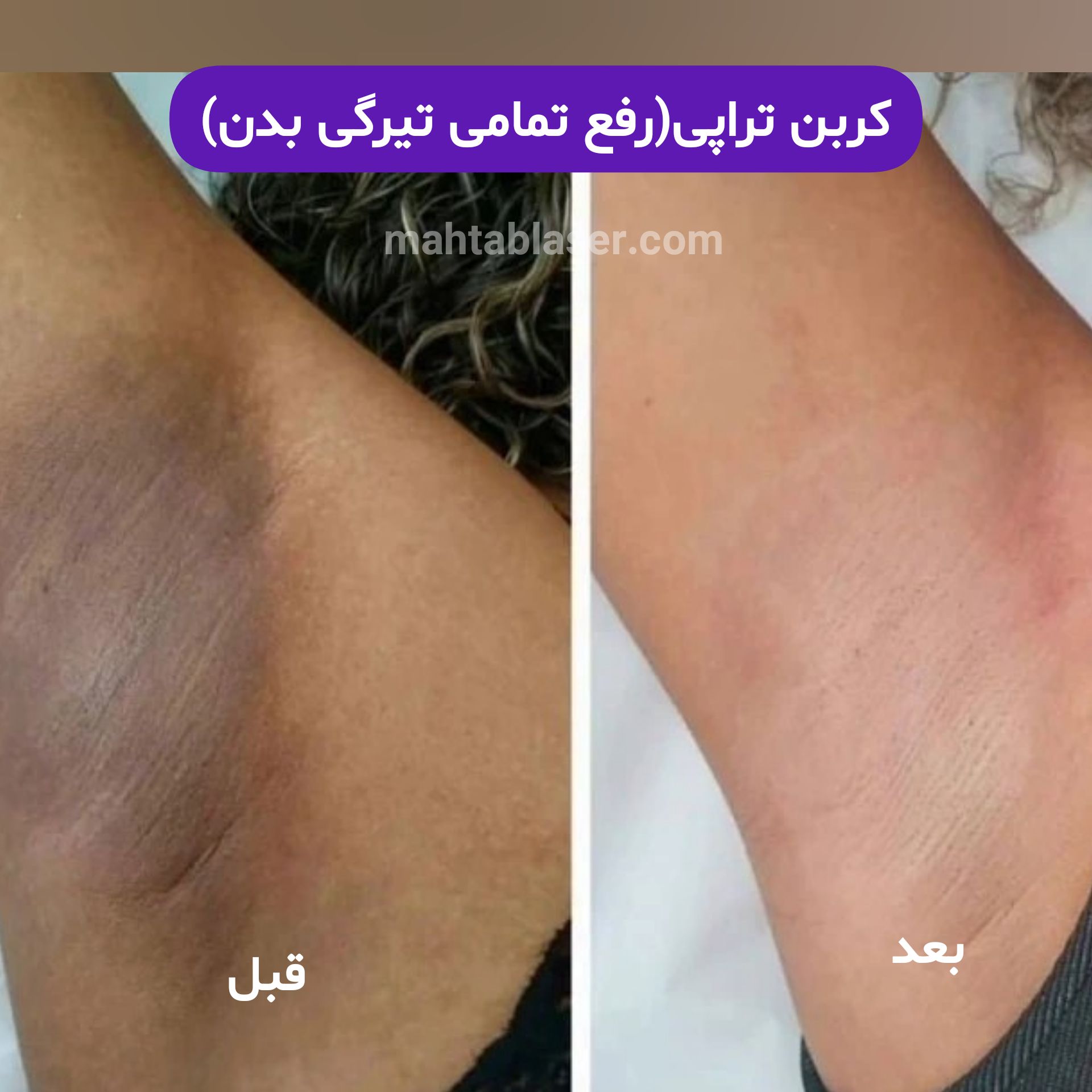 کربن تراپی در استان گیلان شهر رشت