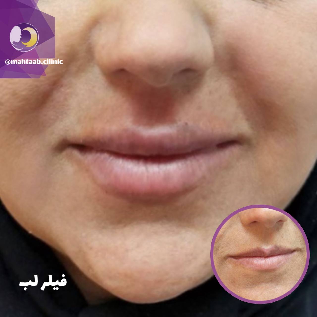 تزریق ژل لب و فیلر لب در کرج